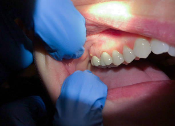 Best Emergency Dentist for Knocked-Out Tooth in Berthoud, CO